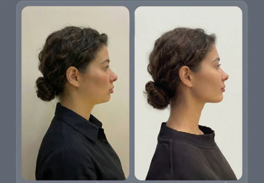 Oferta Especial: Faja Facial Reafirmante – Define y Moldea tu Rostro